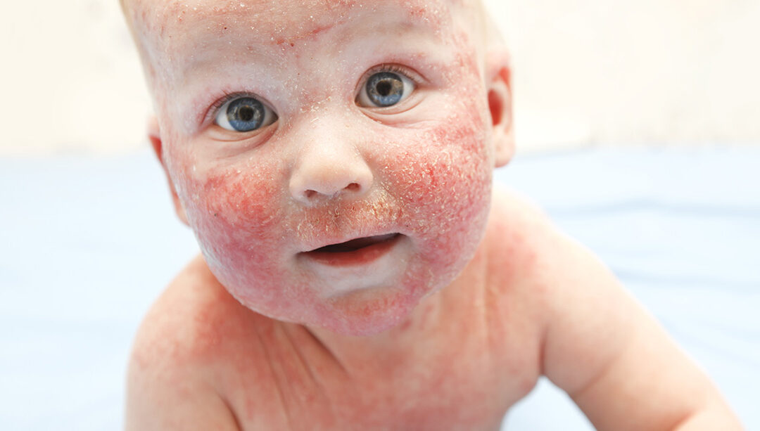 Bambino con dermatite atopica