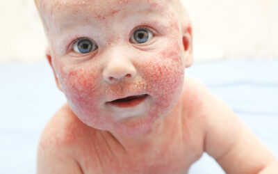 Associazione tra eczema atopico e disturbo da deficit di attenzione / iperattivit&agrave;. Meta-analisi di studi epidemiologici